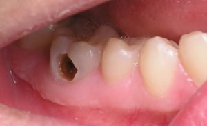 Bọc răng sứ cho răng sâu – Giải pháp được chuyên gia khuyên dùng