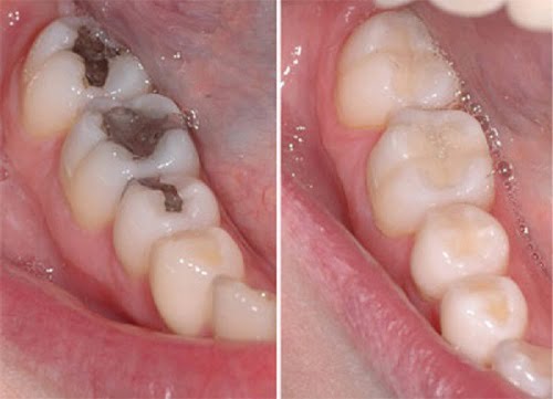 bọc răng sứ cho răng sâu