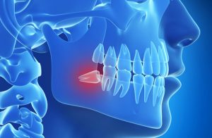 Nhổ răng số 8 : Những điều nên biết để tránh nguy hiểm