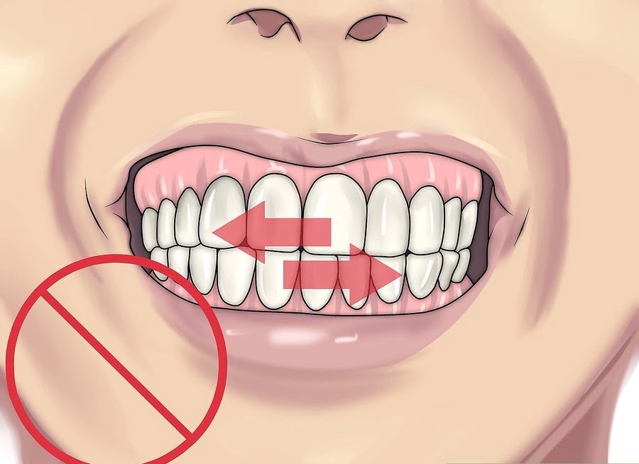tránh nghiến răng