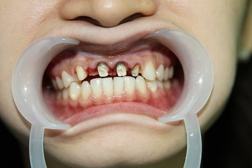 Hậu quả của bọc răng sứ