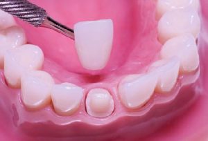 Bọc răng sứ cho răng hô có hiệu quả không?