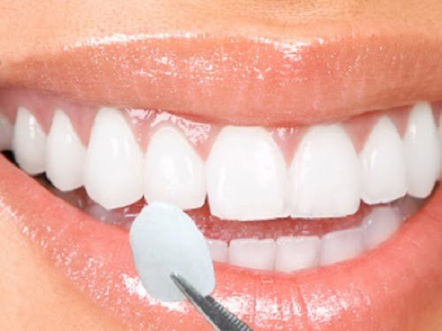 Răng sứ Veneer có tốt không?