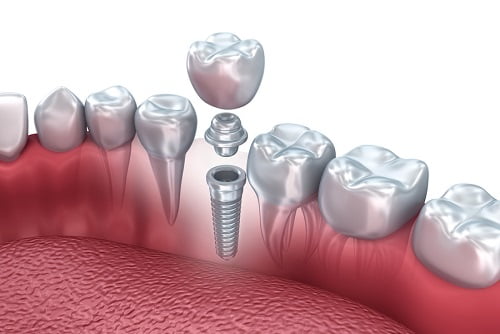 Răng implant có bị đào thải không