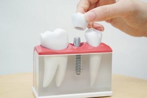 Trồng răng implant mất bao lâu? Thời gian để hoàn thiện