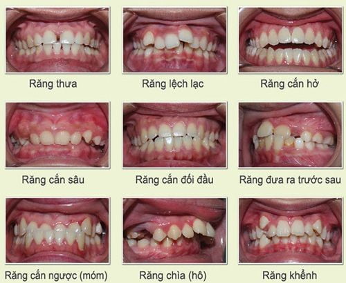Niềng răng mất bao lâu?