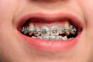 Niềng răng mắc cài kim loại giá bao nhiêu? – Tư vấn chỉnh nha