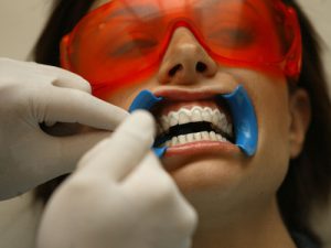 Có nên tẩy trắng răng không? – Những vấn đề liên quan