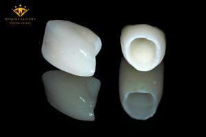 Mão răng sứ là gì? Bọc mão răng sứ an toàn – Đẹp – Nhanh