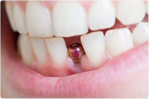 Có nên trồng răng implant hay không