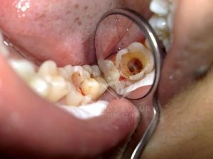 Nhổ răng cấm bao nhiêu tiền? Tổng hợp kiến thức cần biết
