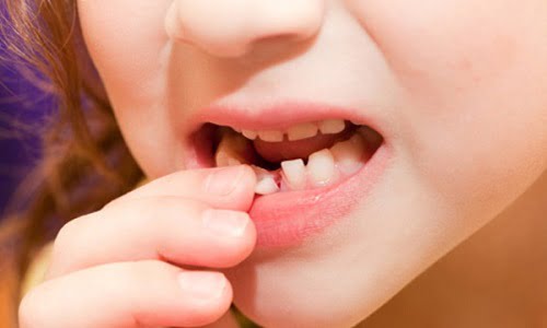 nhổ răng cho trẻ em