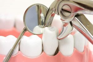 Nhổ răng số 4 có ảnh hưởng gì không? – Những điều bạn nên biết