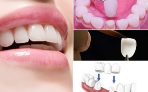 Phục hình răng sứ – Giải pháp làm đẹp răng nhanh chóng, tự nhiên