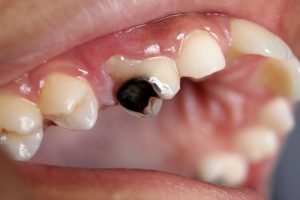 Chăm sóc nướu răng tốt để răng miệng khỏe khi già – Bệnh thường gặp