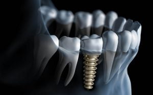 Các biến chứng implant – Làm thế nào để tránh được?