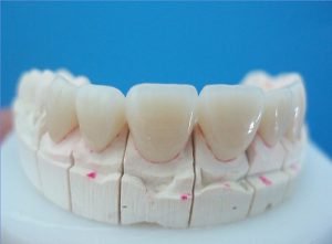 Tuổi thọ của răng sứ là bao nhiêu năm?