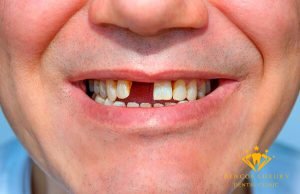 Mất 1 răng nên cấy implant hay trồng răng sứ? Giải pháp cho bạn