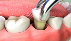 Nhổ răng số 5 có nguy hiểm không? – Chuyên gia nha khoa tư vấn