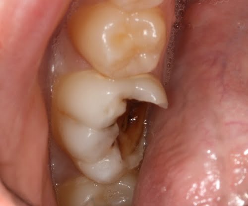 Nhổ răng số 5 có nguy hiểm không?