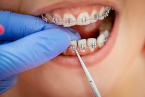 Quy trình niềng răng đúng chuẩn sẽ diễn ra theo trình tự nào?