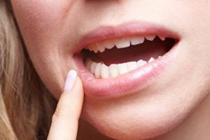 Răng khôn mọc lệch ra má: Nguy hiểm khó lường nếu không xử lý ngay