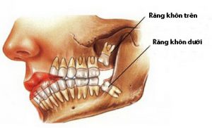Mọc răng khôn hàm trên – Những biến chứng nguy hiểm bạn nên biết