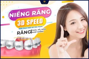 Niềng răng mắc cài công nghệ 3D Speed – Sự lựa chọn ưu Việt nhất