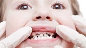 Bệnh sâu răng ở trẻ em – Nguyên nhân – Biện pháp can thiệp triệt để