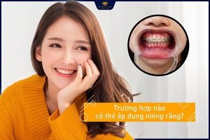 Niềng răng mắc cài – Sự lựa chọn ưu Việt