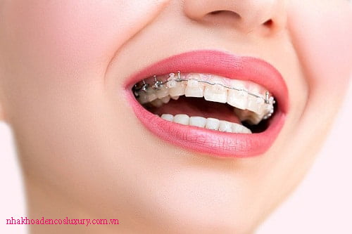 Trường hợp nào nên áp dụng niềng răng vẩu?