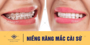 [MỚI] Hình ảnh niềng răng mắc cài sứ | Khách hàng thực 100%