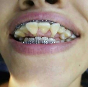 Tác hại của niềng răng tại Nha khoa ‘dỏm’ – Hình ảnh khiến bạn rùng mình