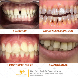 Phục hình răng sứ – Giải pháp chinh phục hàm răng thiếu thẩm mỹ