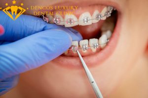 Quy trình niềng răng Hô, Móm – 4 bước để có hàm răng ĐẸP