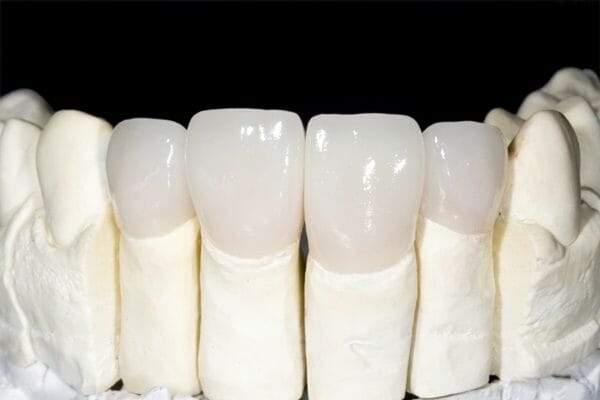 bọc răng sứ không kim loại