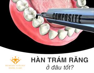 Trám răng ở đâu tốt? – Địa chỉ đứng TOP tại Hà Nội
