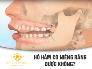 Hô hàm có niềng răng được không? – BS niềng răng GIỎI trả lời cho bạn