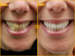 Kết quả sau khi niềng răng – Những hình ảnh trước và sau khi niềng