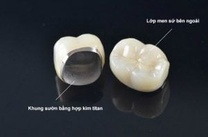 Răng sứ titan là gì? Đối tượng, hình ảnh trước và sau khi thực hiện