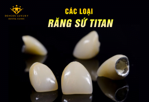 Răng sứ titan có mấy loại? Loại nào tốt và thông dụng nhất?