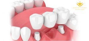 Tìm hiểu về cầu răng sứ là gì? Ưu điểm, quy trình ra sao?