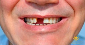 Cầu răng sứ cho răng cửa có được không? – Tư vấn từ BS nha khoa