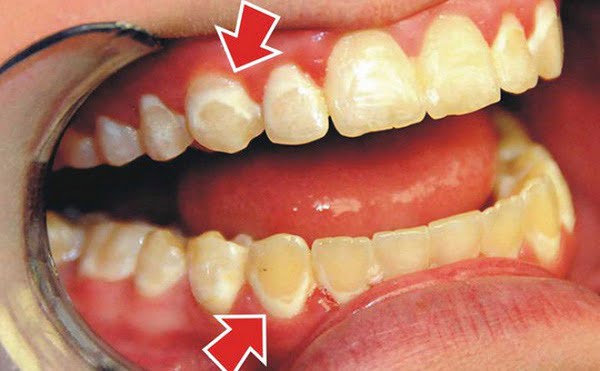 bệnh nha chu ở răng miệng