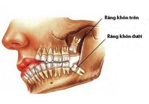 Mọc răng khôn hàm trên có đau không? – Biến chứng và cách xử lý