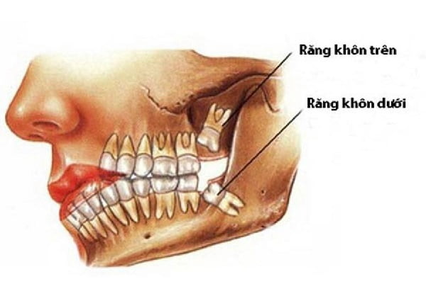 Mọc răng khôn hàm trên có đau không