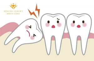 Mọc răng khôn đau răng – Cách giảm đau chỉ mất 5 phút