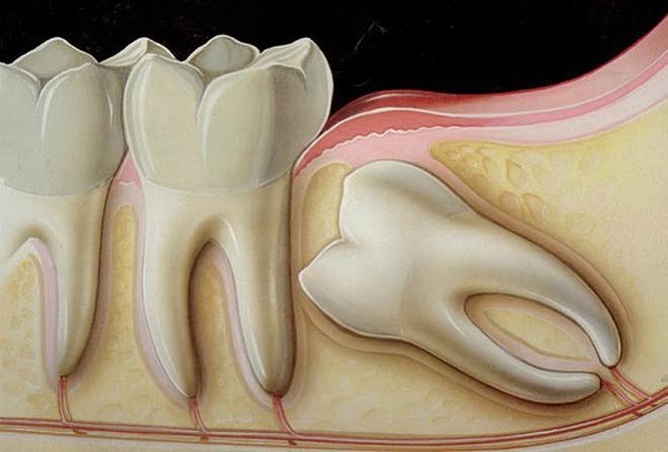 4. Các phương pháp xử lý răng khôn mọc xéo