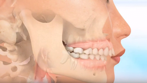 Răng hô là bệnh gì? – Các phương pháp điều trị răng hô hiệu quả