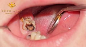 Sâu răng ăn vào lợi – Biểu hiện và cách điều trị “Hiệu Qủa”